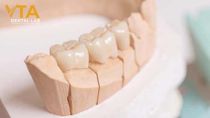 Exploring Dental Implant Alternatives for Molars: What Are Your Options?