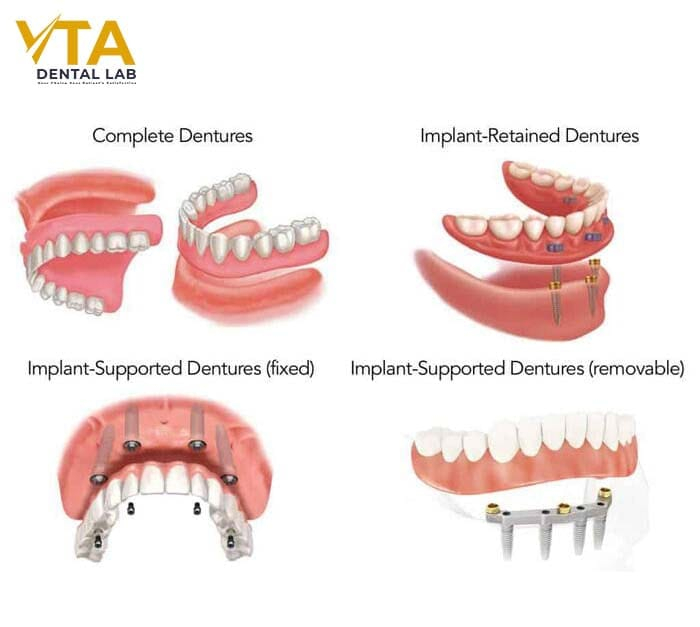 Removable dentures offer a versatile and affordable solution