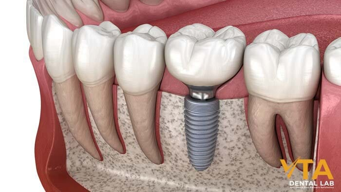 Dental implants are advanced replacements for missing teeth that provide a long-term solution