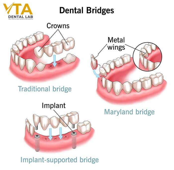 Dental bridges help the patient can chew and bite easily