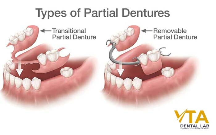 Partial dentures can quite literally bridge the gap