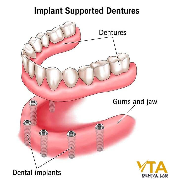 Implant-Supported Dentures