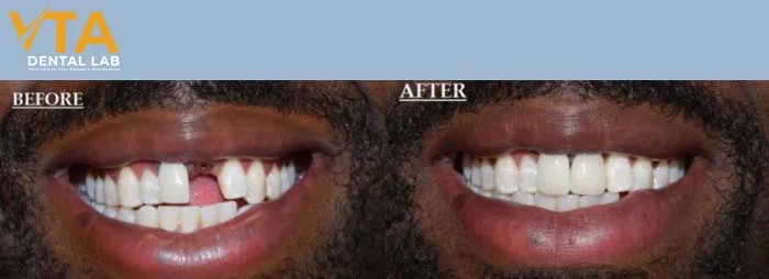 Improves the health of the surrounding bone and gums