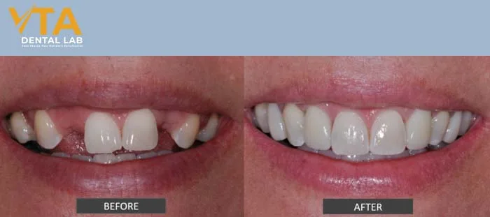 Dental implant for multiple missing teeth