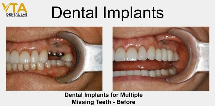 The implant post is a crucial role for an artificial root tooth