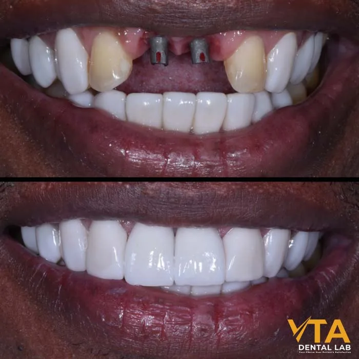 A dental implant replaces your missing tooth without involving the neighboring teeth