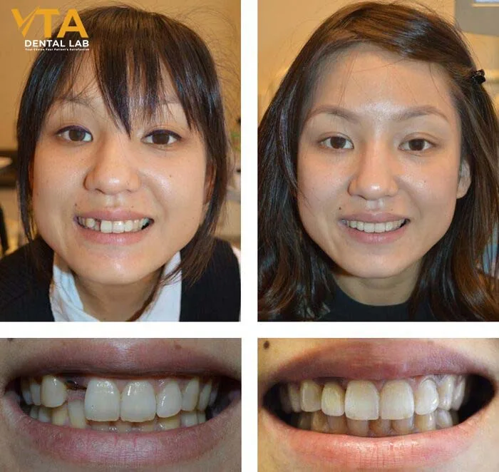 Dental implant restores cosmetic appearance