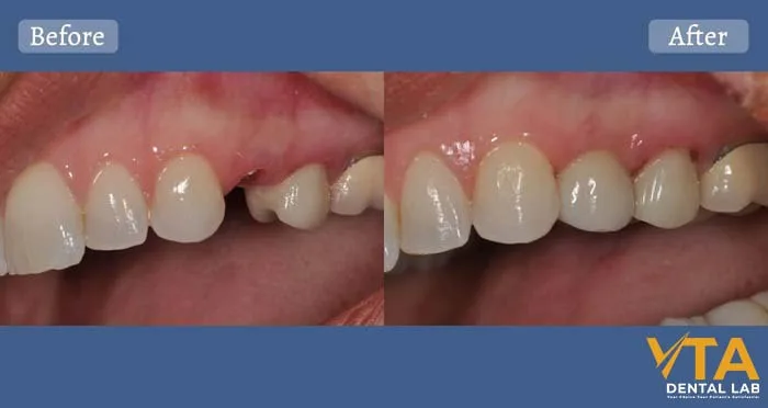 Dental implants can significantly improve the quality of life and the health