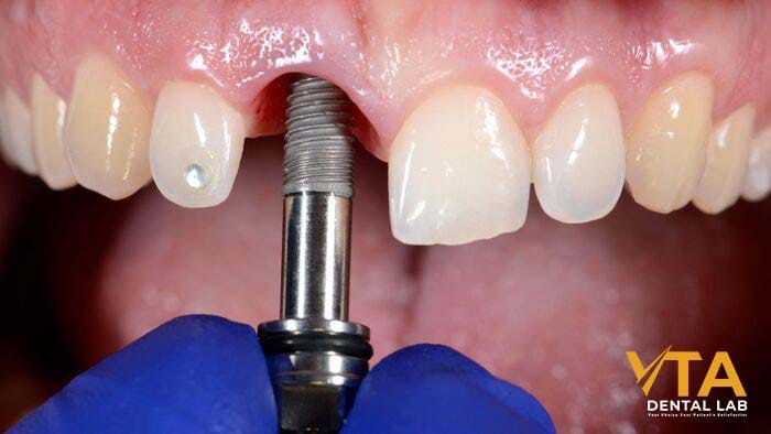 Is a dental implant painful during surgery?