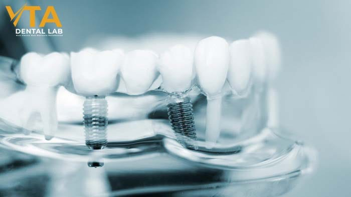 Does implant teeth hurt?  Pain Levels and Recovery Tips