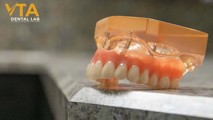 Full-mouth denture implants: A Comprehensive Solution