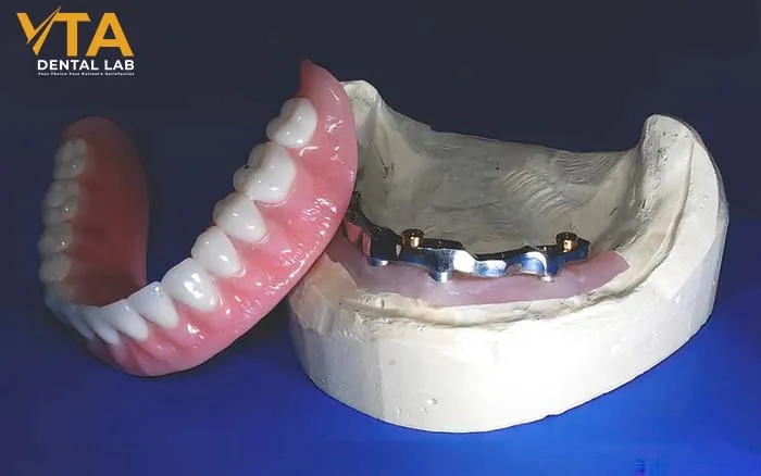 Implant Overdenture