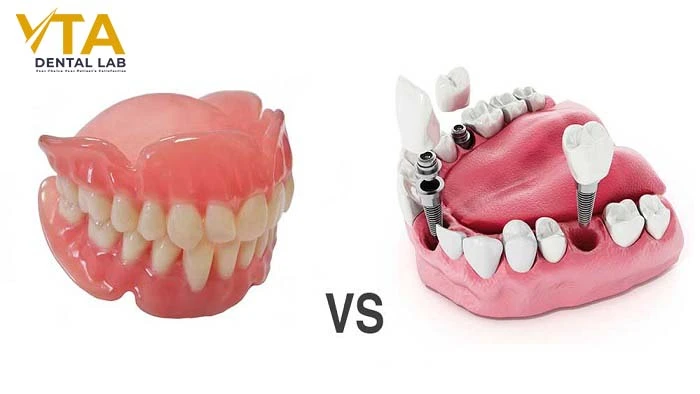 Dental Implants vs Dentures:  Which is The Best For You