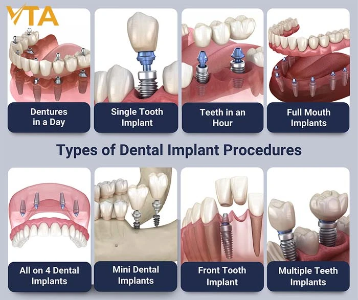 Dental-Implantsvs-Dentures