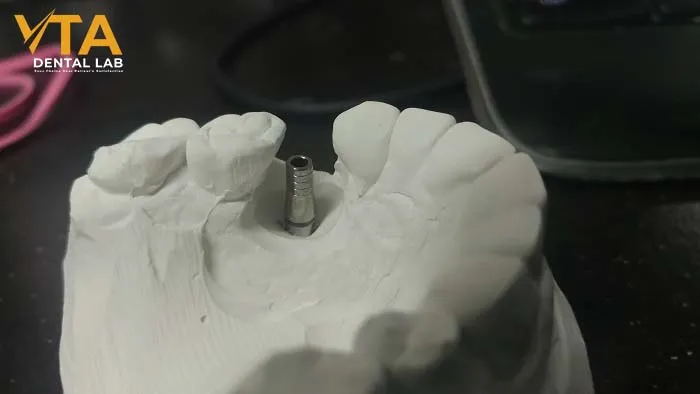 Dental implant abutments: Types, Materials, and Benefits