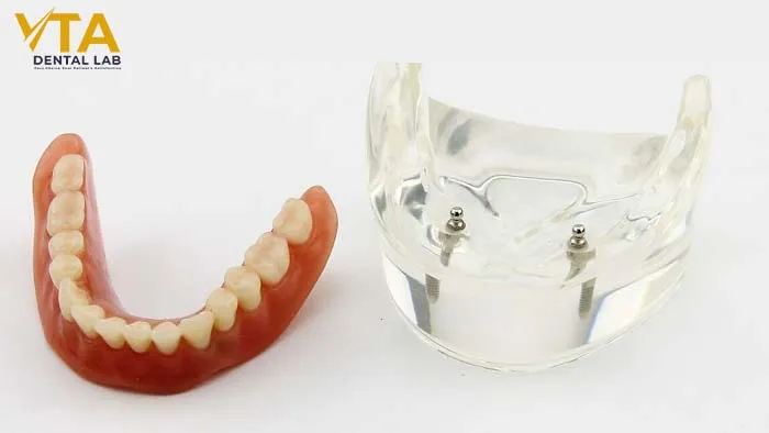 Implant Overdenture: The Perfect Solution for Stable and Convenient