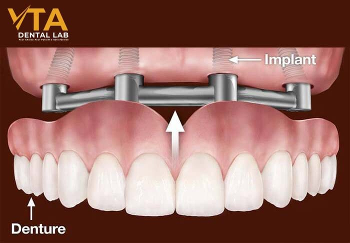 Denture Implant Procedure 