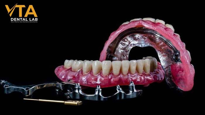 A Step-by-Step Guide to the Denture Implant Procedure