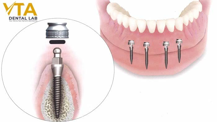 What are mini dental implants? Cost and Procedure