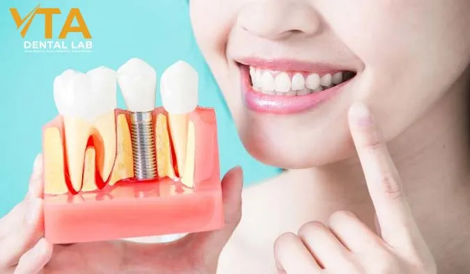 Post-Dental Implant Care Instructions: A Comprehensive Guide