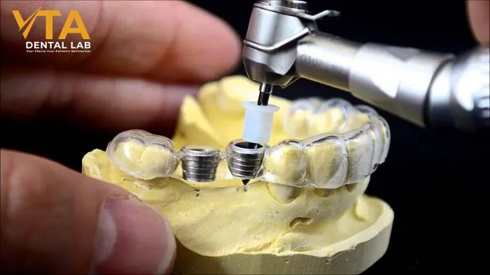 Implant Surgical Guide and Digital Treatment Planning