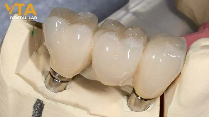 What is an implant teeth bridge? Advantages and Workflow