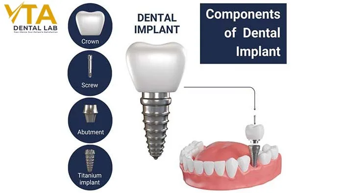 Parts of Dental Implants: Key Components for a Perfect Smile