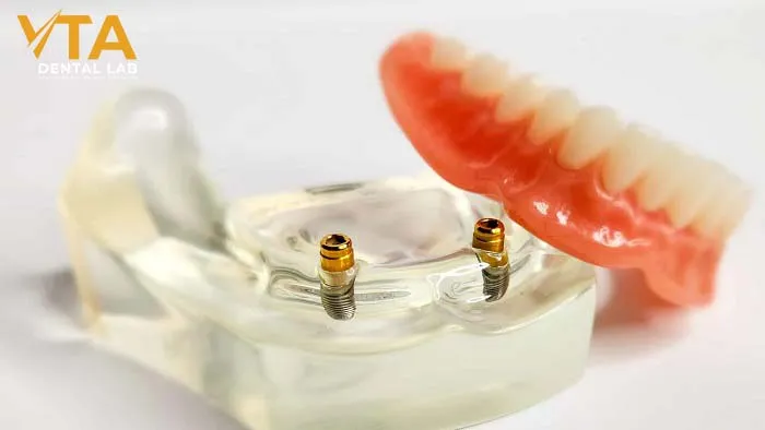 Snap-in Dentures: A Secure and Comfortable Solution for Missing Teeth