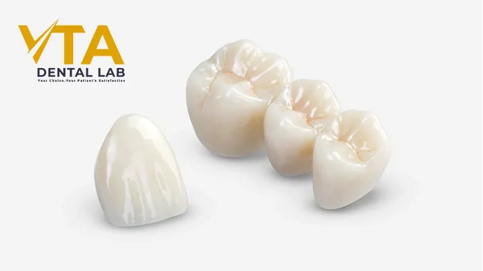 Ceramic Crown: A Popular Choice For Permanent Restoration