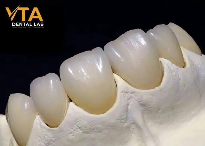 Ceramic-Crown-A-Popular-Choice-For-Permanent-Restoration