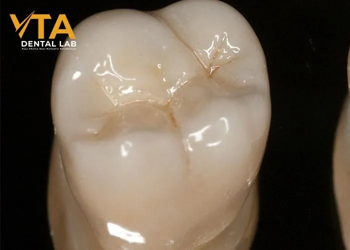 Ceramic-Crown-A-Popular-Choice-For-Permanent-Restoration