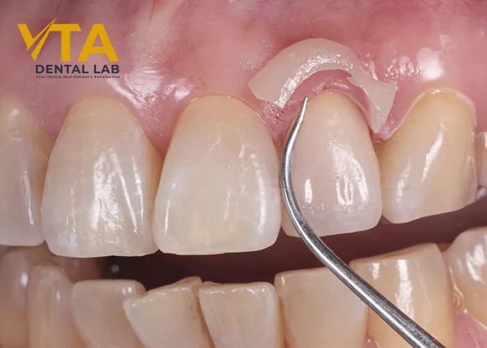 Crown-Cementation-Clinical-Guidelines-And-Tricks