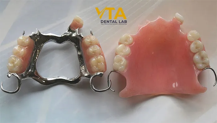 Comparison between acrylic partial denture and metal partial denture designs