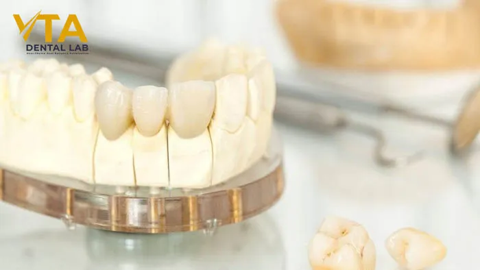Understanding the Dental Crown Procedure