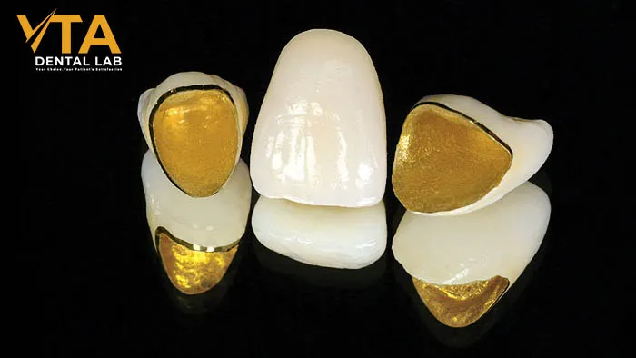 PFM Crown: Alloys Used, Advantages, and Potential Limitations