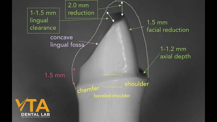 Guidelines for PFM Crown Tooth Preparation