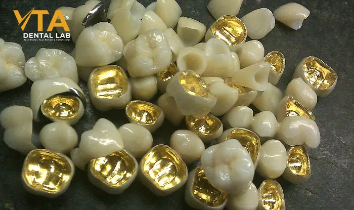 Both metal and porcelain are highly durable materials, able to withstand chewing stress and years of use