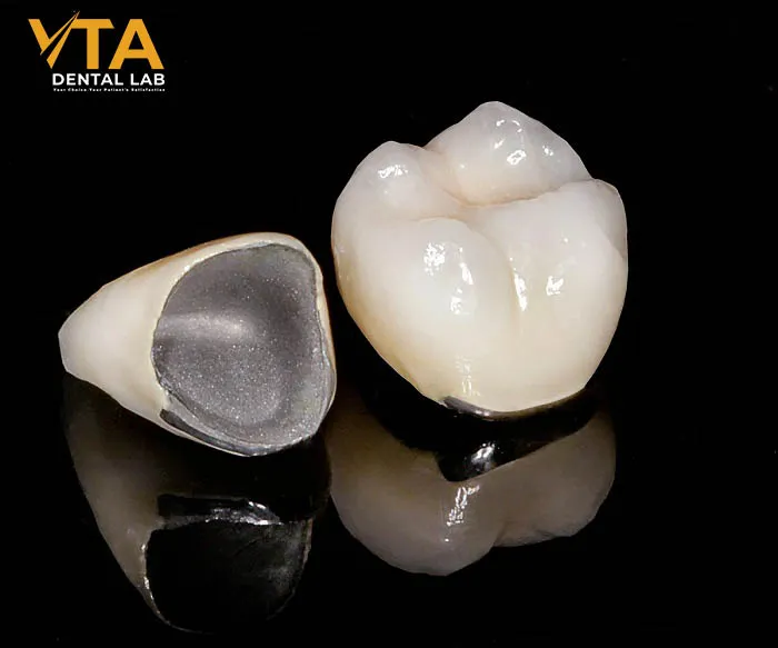 Porcelain-fused-to-metal (PFM) crowns have been considered the gold standard for the repair of damaged teeth