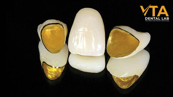 An inside look at the dual-layer structure of PFM Crowns, combining metal core and porcelain overlay