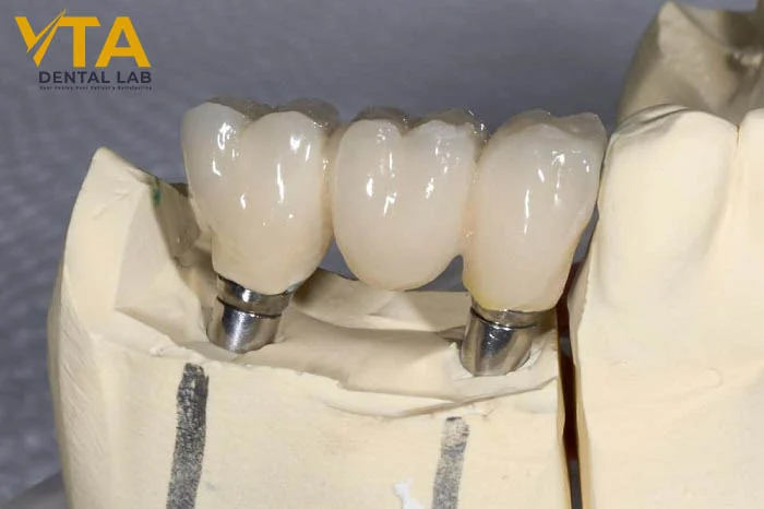 Close-up of full-contour Zirconia Crowns demonstrating lifelike shading and smooth finish