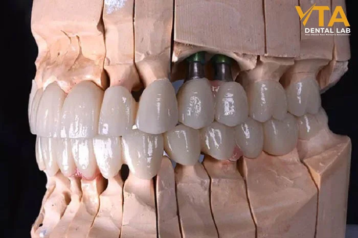 Full-arch restoration using Zirconia Crowns crafted for long-term function and beauty
