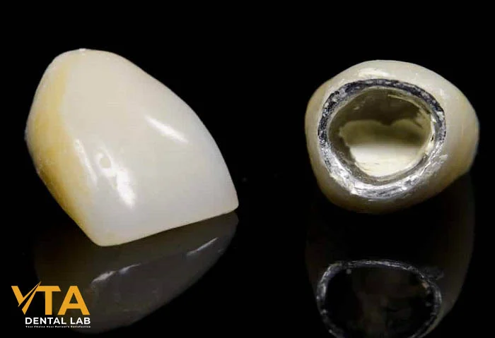 See how PFM Crowns maintain longevity in high-stress occlusal zones over a decade