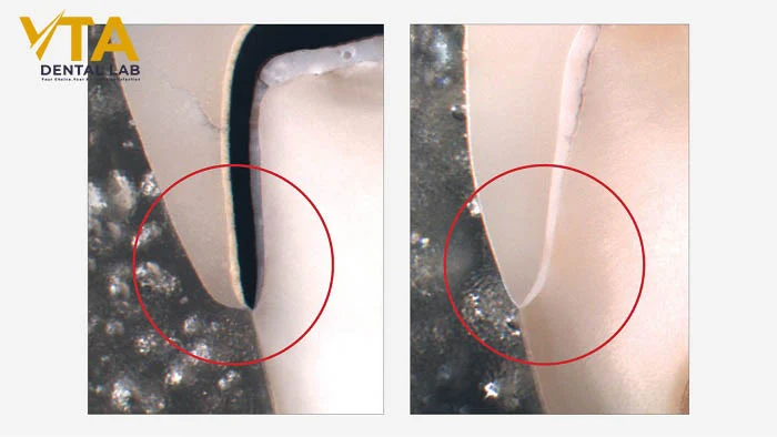 A side-by-side comparison of PFM Crowns vs Zirconia Crowns highlighting differences in translucency and metal substructure