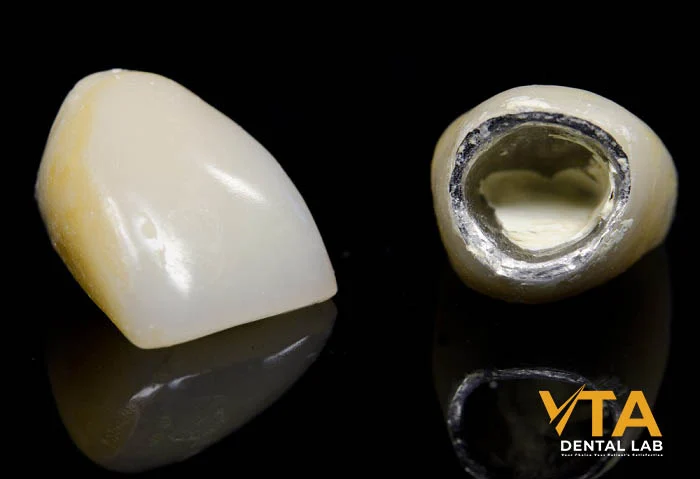 Porcelain-fused-to-metal crown combining strength with proven long-term performance