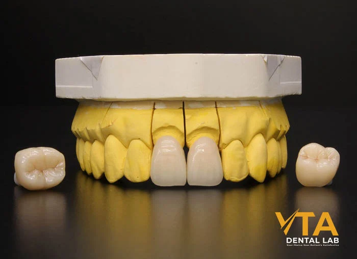 Porcelain crowns offer lifelike aesthetics, perfect for restoring front teeth