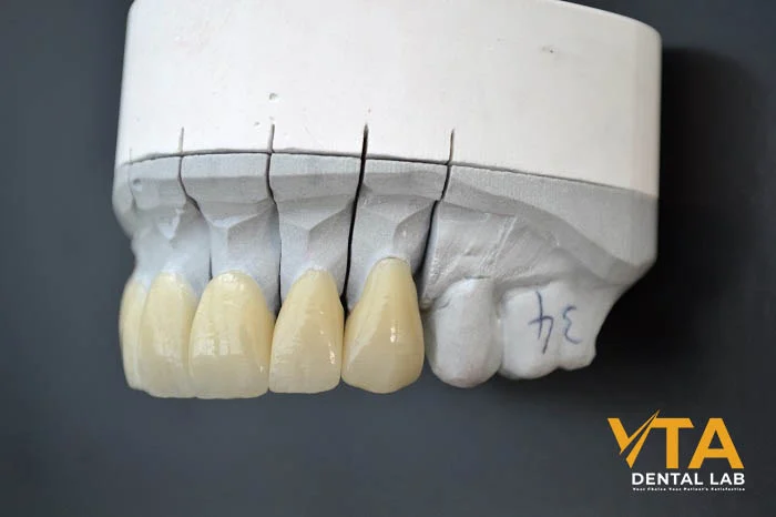 Demonstrating the natural translucency and fit of custom-made porcelain crowns