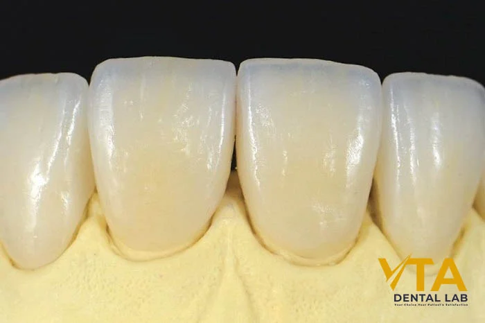 Showcasing the natural translucency of an all-porcelain crown ideal for front teeth restorations