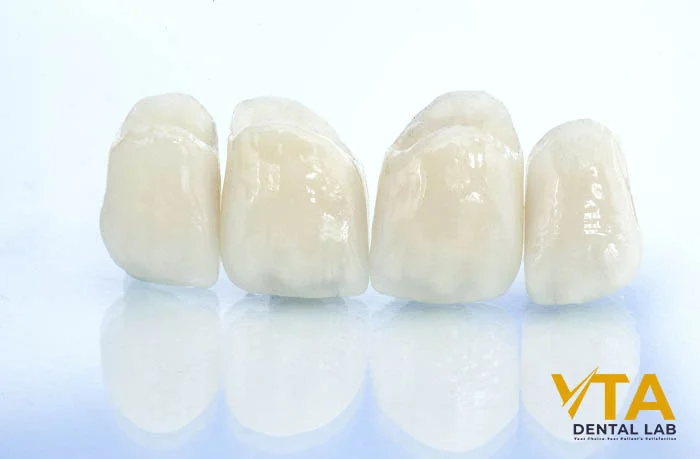 High-aesthetic lithium disilicate crown designed for strength and beauty in anterior zones