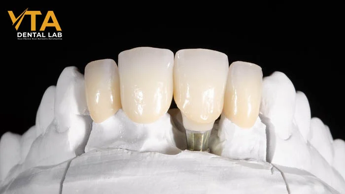 Digital workflow in progress for high-precision zirconia crown fabrication
