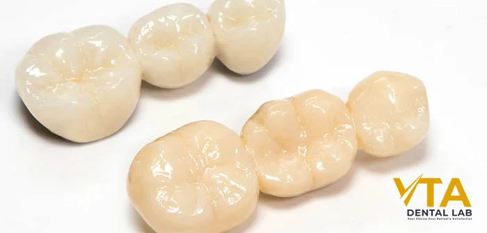 Porcelain-fused-to-zirconia crown offering enhanced aesthetics with a strong zirconia core
